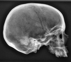 Skull radiograph